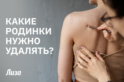 Знаки на коже: какие родинки могут быть опасны для здоровья