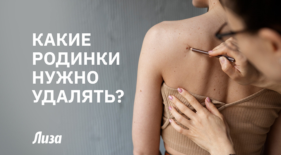 Знаки на коже: какие родинки могут быть опасны для здоровья