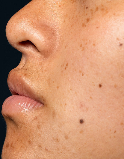 Что значат родинки на лице: трактовка приметы