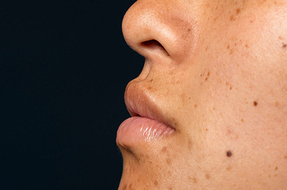 Что значат родинки на лице: трактовка приметы