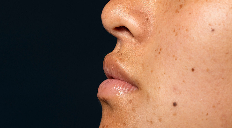 Что значат родинки на лице: трактовка приметы