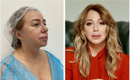 Никакой пластики: Алена Апина рассказала обо всех проделанных процедурах по омоложению