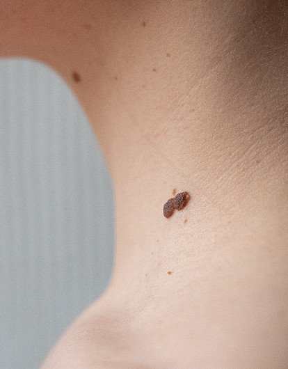 Что значит родинка на шее: расшифровка приметы по количеству и расположению на коже