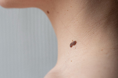 Что значит родинка на шее: расшифровка приметы по количеству и расположению на коже