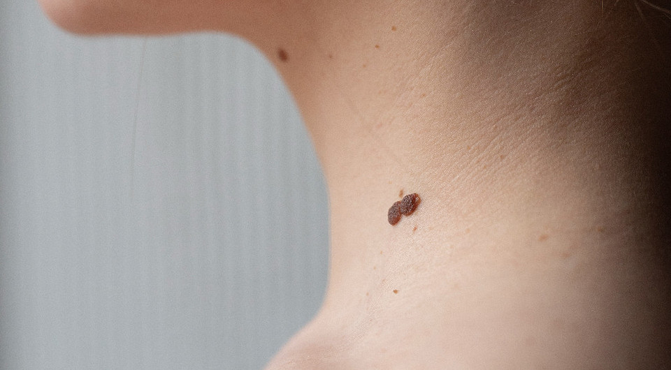 Что значит родинка на шее: расшифровка приметы по количеству и расположению на коже