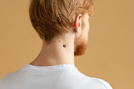 Что значит родинка на шее: расшифровка приметы по количеству и расположению на коже