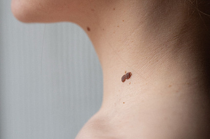 Значение родинок на щеке: трактовка отметин на правой и левой стороне