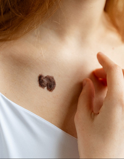 Что значат родимые пятна на теле: трактовки с точки зрения эзотерики