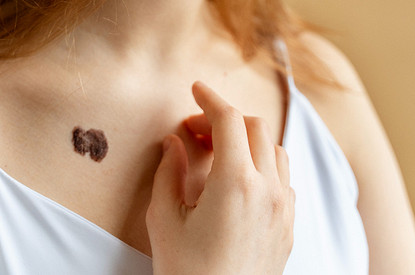 Что значат родимые пятна на теле: трактовки с точки зрения эзотерики