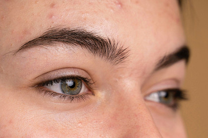 Что значит прыщ на лбу с точки зрения примет