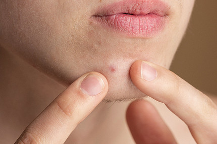Прыщ на подбородке: что это значит с точки зрения примет