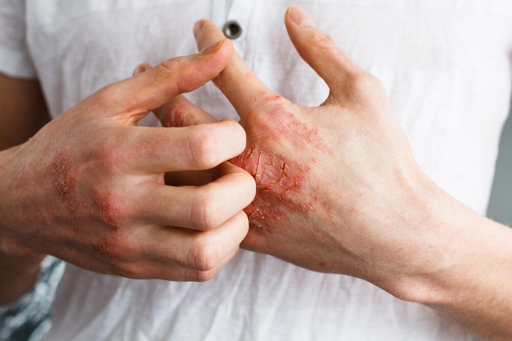 Какие нужны витамины, если трескается кожа на пальцах рук?