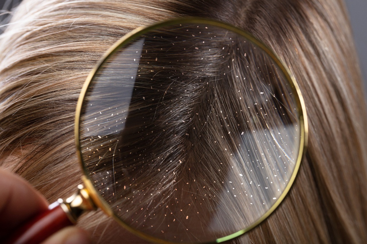 Лечение перхоти в домашних условиях от клиники «Доктор волос»