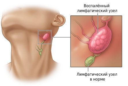 Когда лечение лимфоузлов на шее требует обращения к врачу