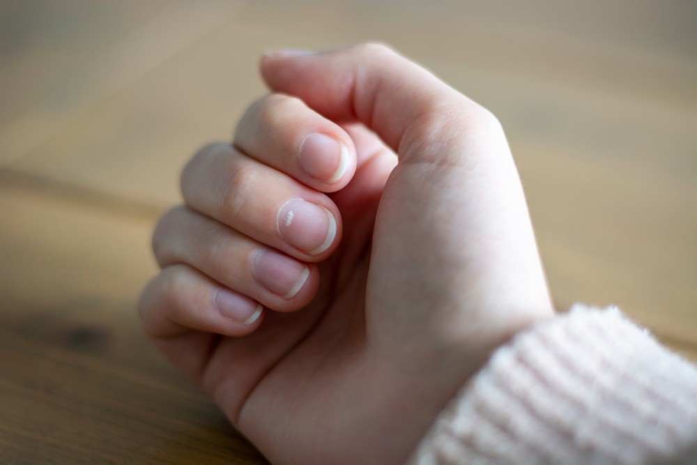 Белые пятна на ногтях: причины появления и как избавиться