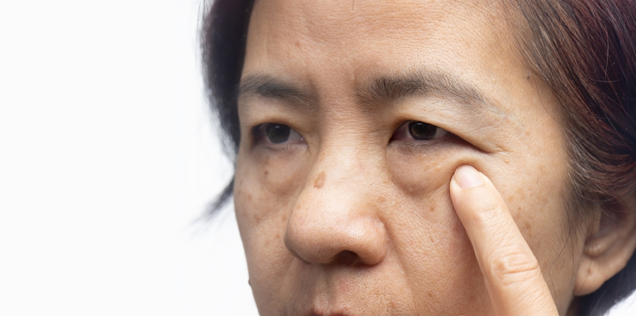 Нервный тик глаз: причины подергивания века и лечение